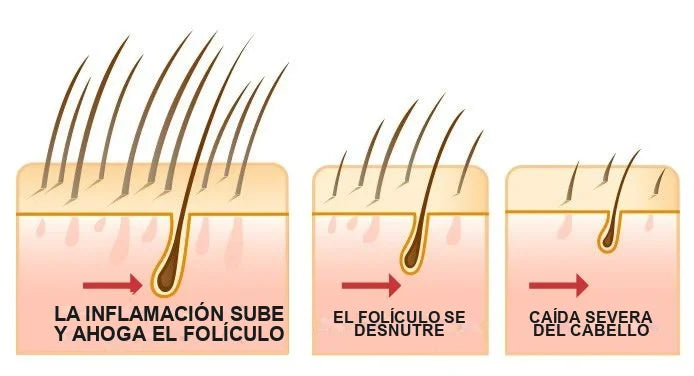 La inflamación del folículo, la causa de raíz