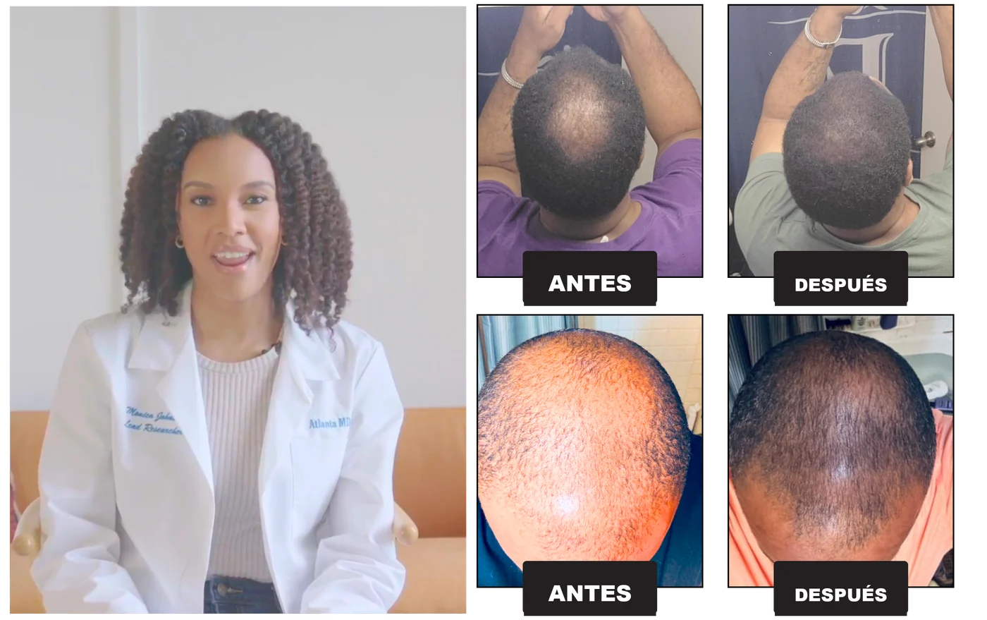 Antes y después del tratamiento capilar